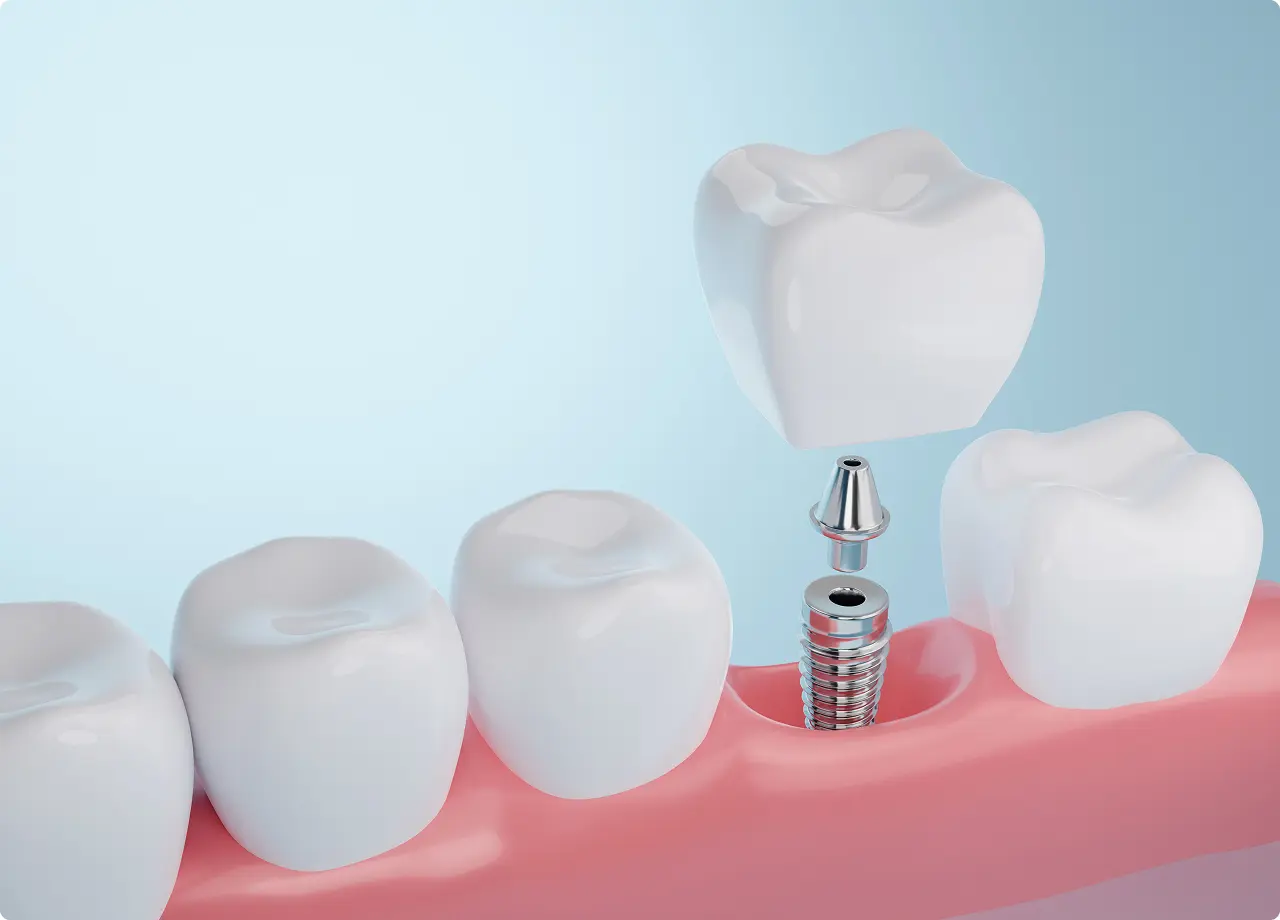 Dental implant diagram with tooth and gum.